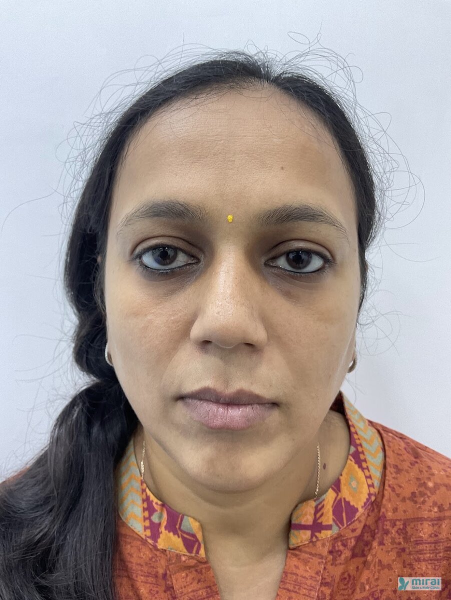 Ami Shah - Before After Microblading