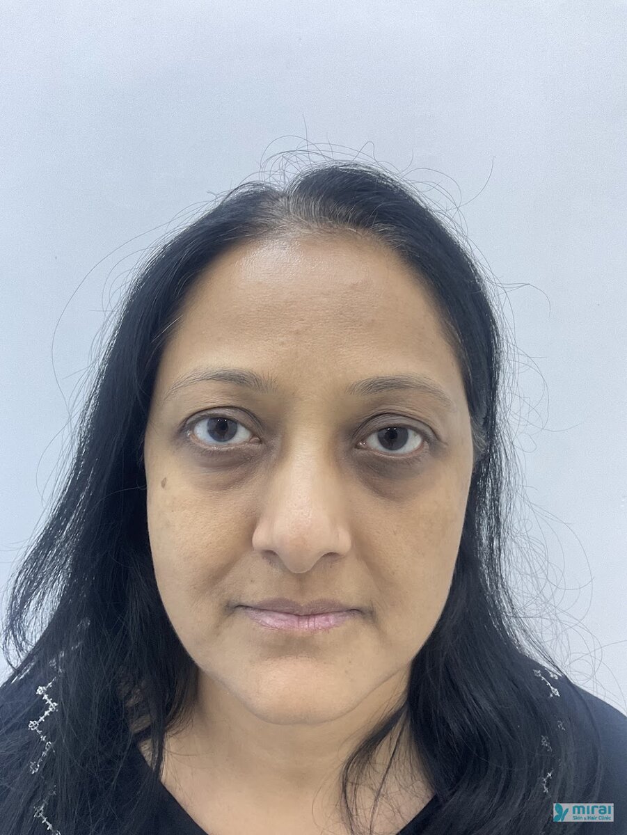 Hetal Patel - Before After Microblading