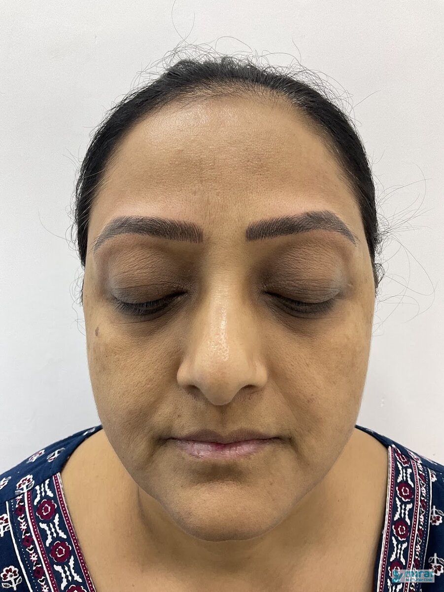 Hetal Patel - Before After Microblading