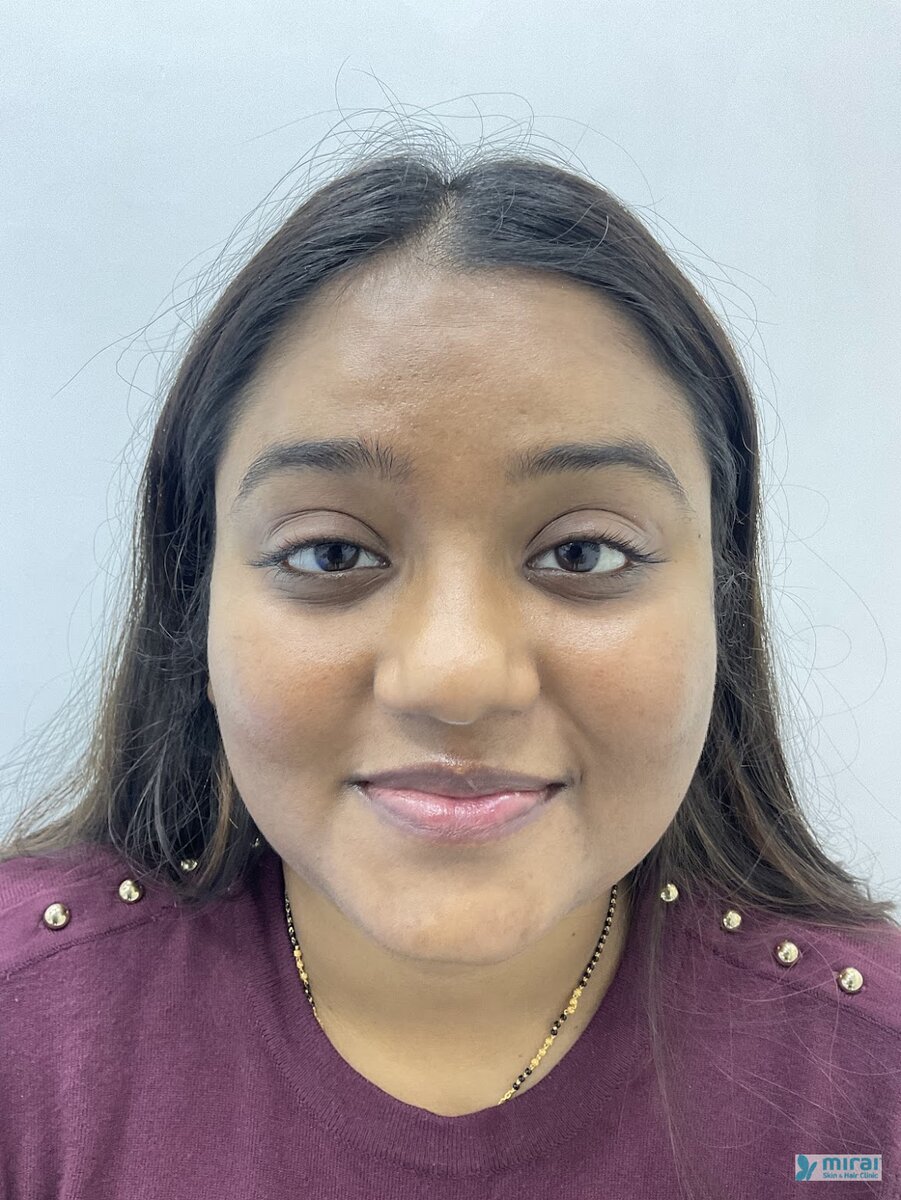 Ishita - Before After Microblading
