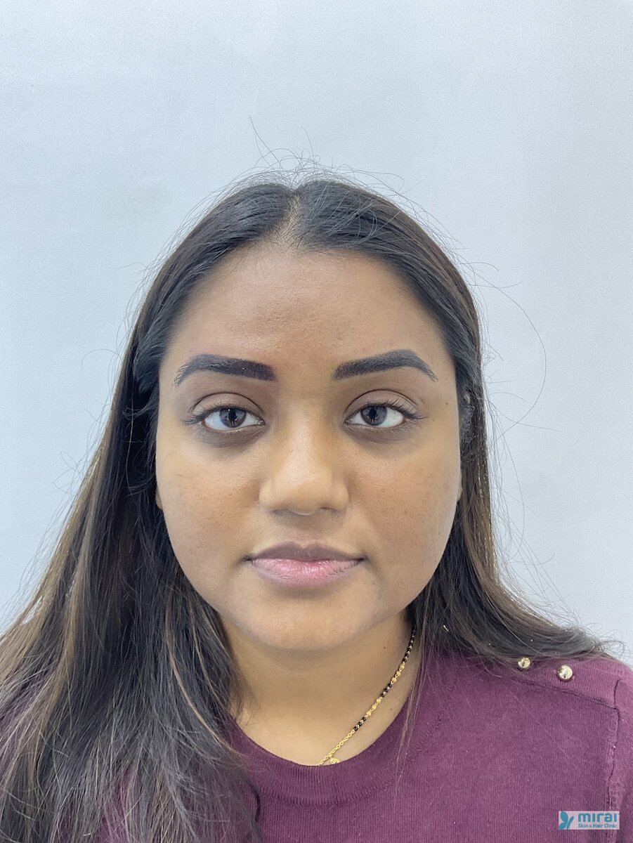 Ishita - Before After Microblading