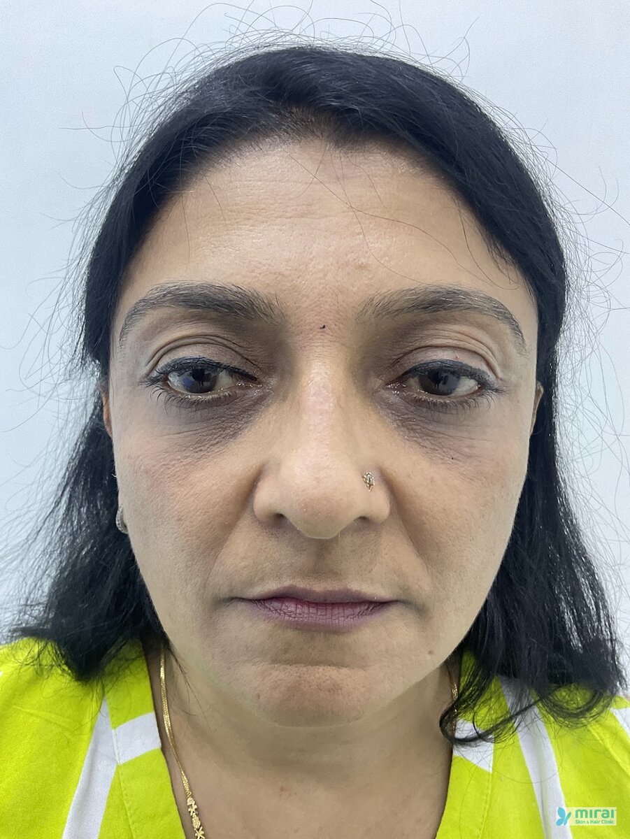 Kajal Shah - Before After Microblading