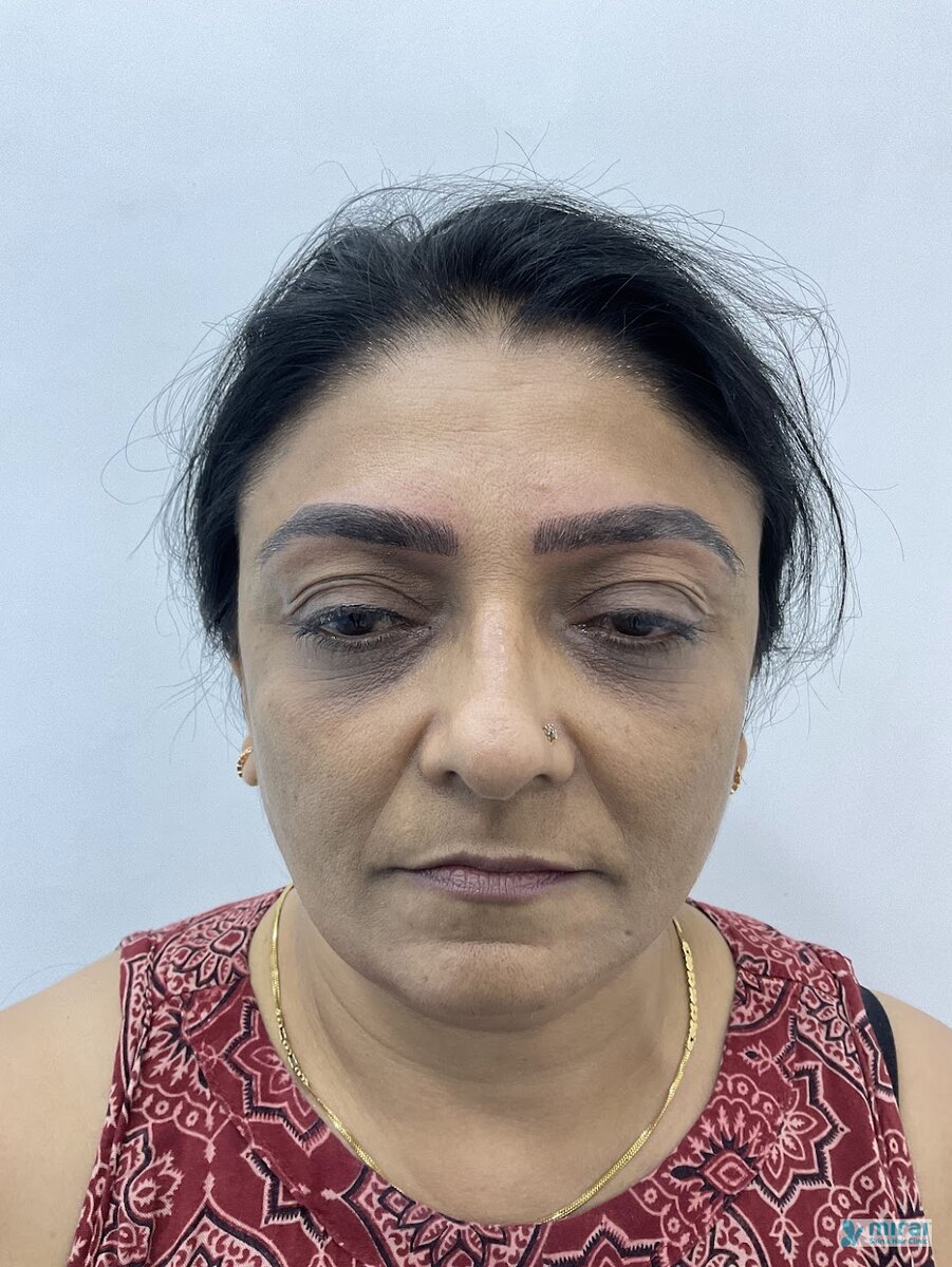 Kajal Shah - Before After Microblading
