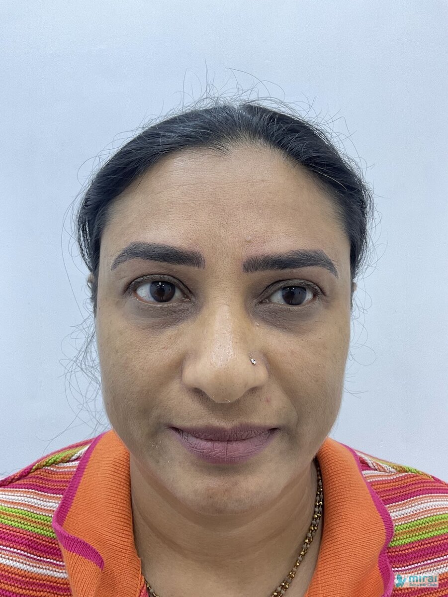 Komal Vagadiya - Before After Microblading