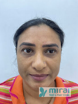 Komal Vagadiya - Before After Microblading