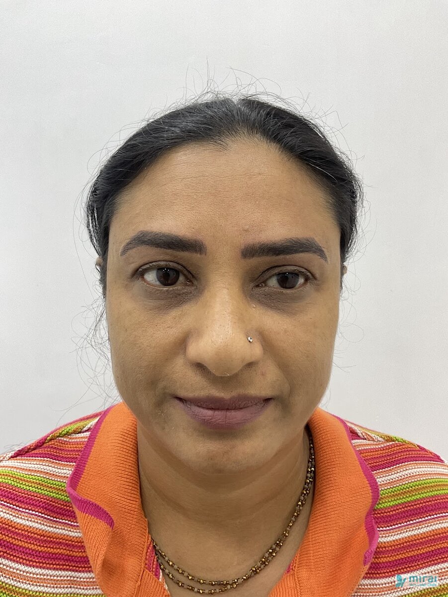 Komal Vagadiya - Before After Microblading