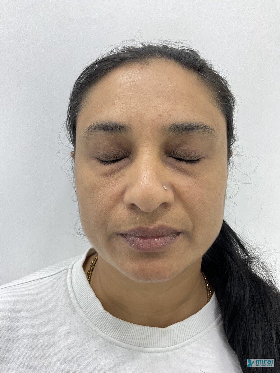 Komal Vagadiya - Before After Microblading
