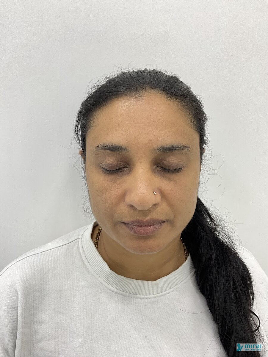 Komal Vagadiya - Before After Microblading