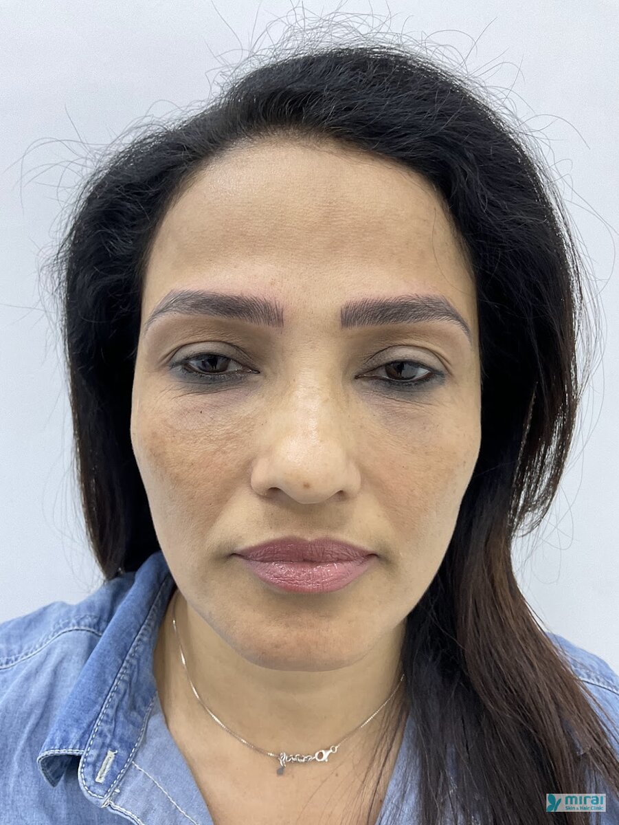 Madhuri Pandit - Before After Microblading