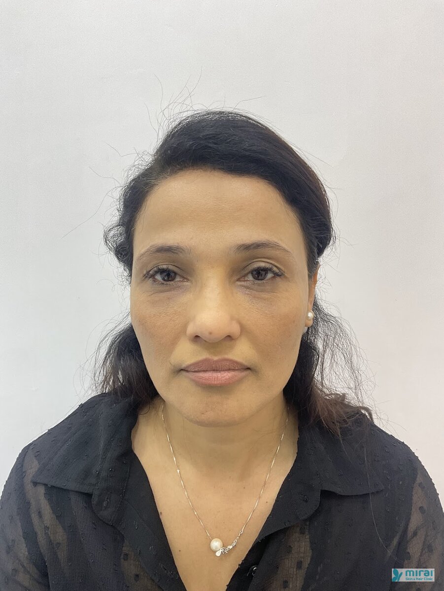 Madhuri Pandit - Before After Microblading