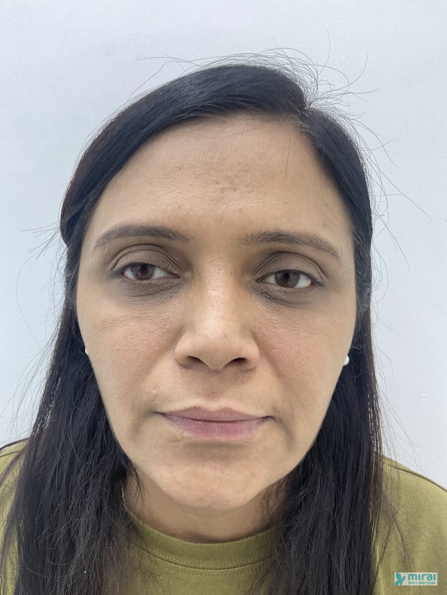 Pooja - Before After Microblading