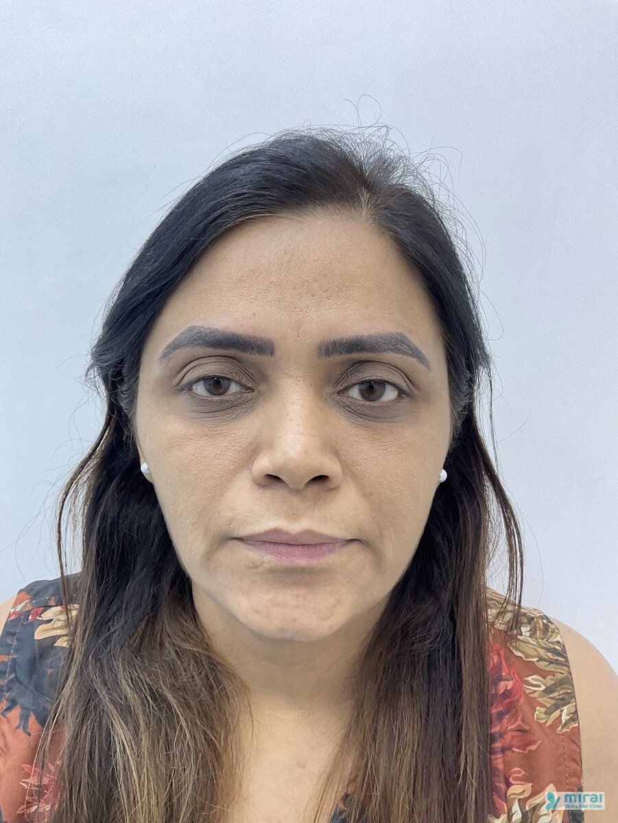 Pooja - Before After Microblading