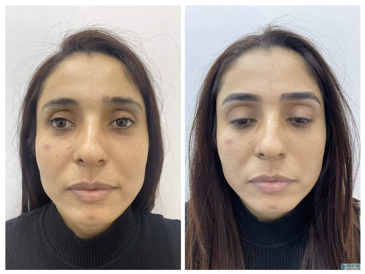 Pooja - Before After Microblading