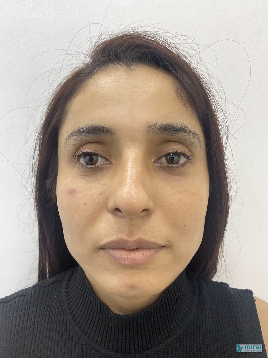 Pooja - Before After Microblading