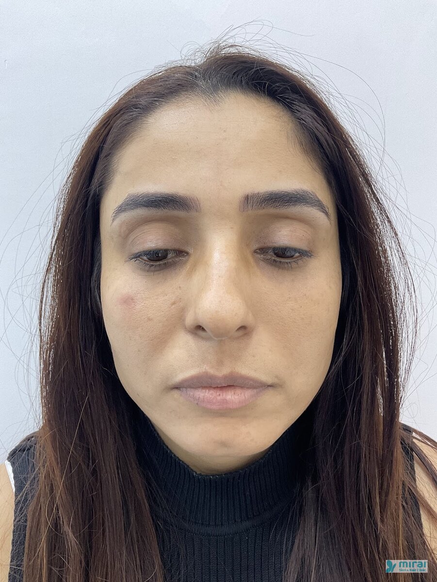 Pooja - Before After Microblading