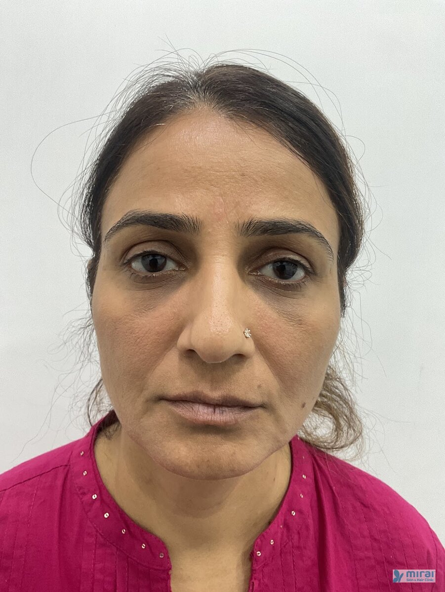Priti Chauhan - Before After Microblading