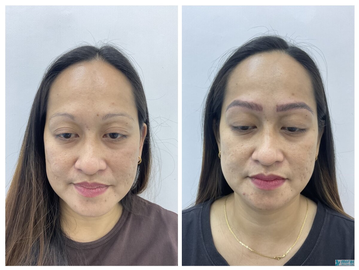 Rinalyn - Before After Microblading