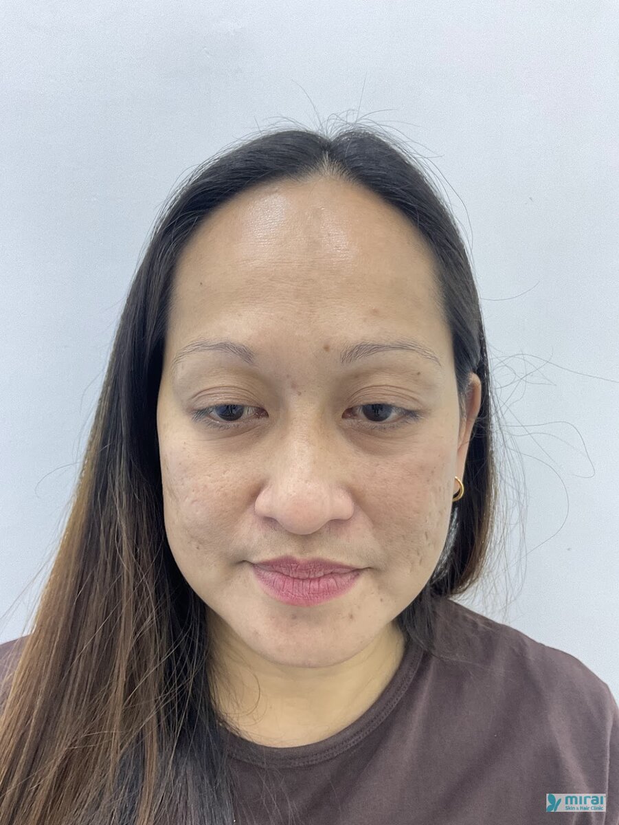 Rinalyn - Before After Microblading
