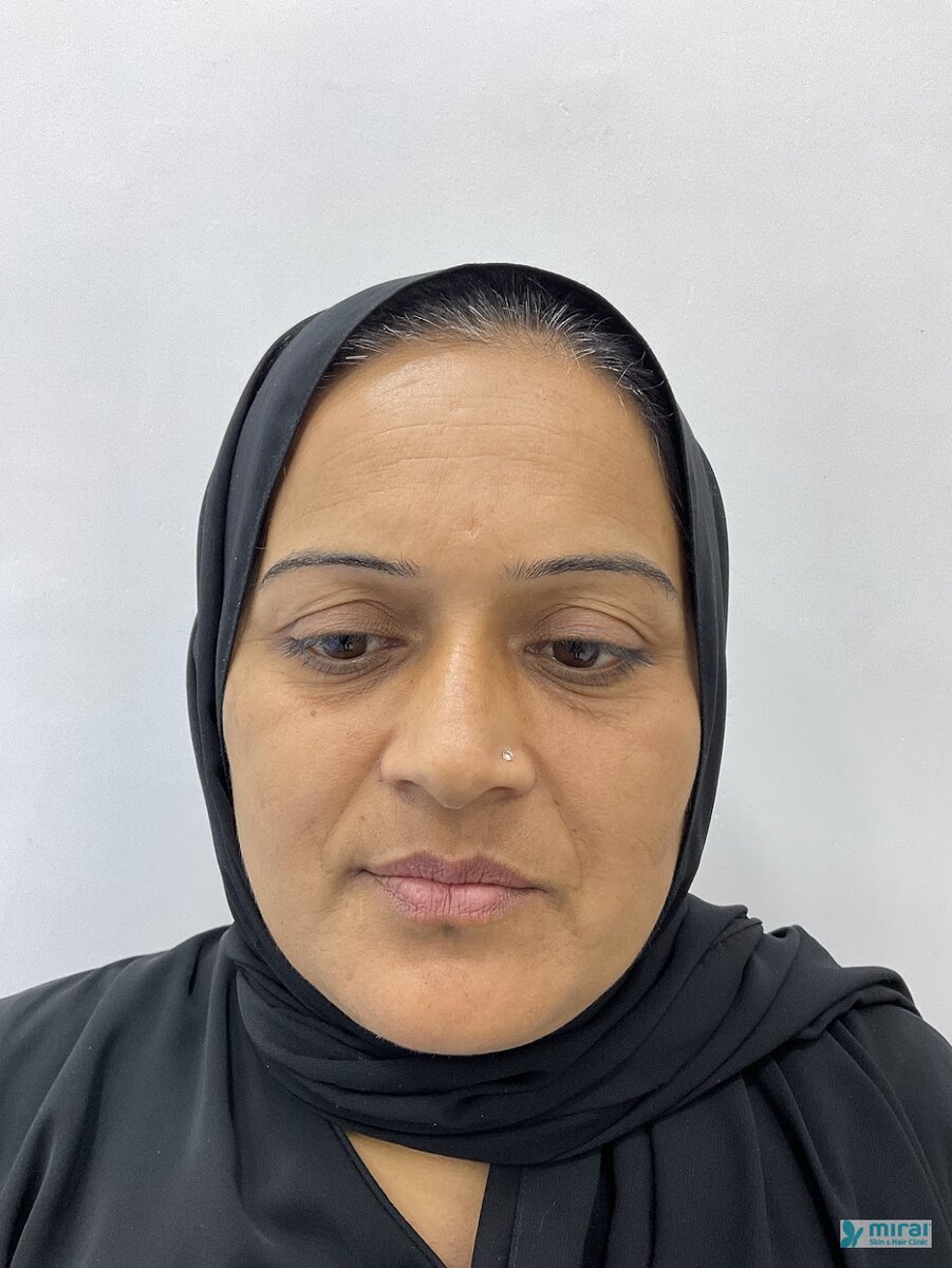 Shabanam - Before After Microblading