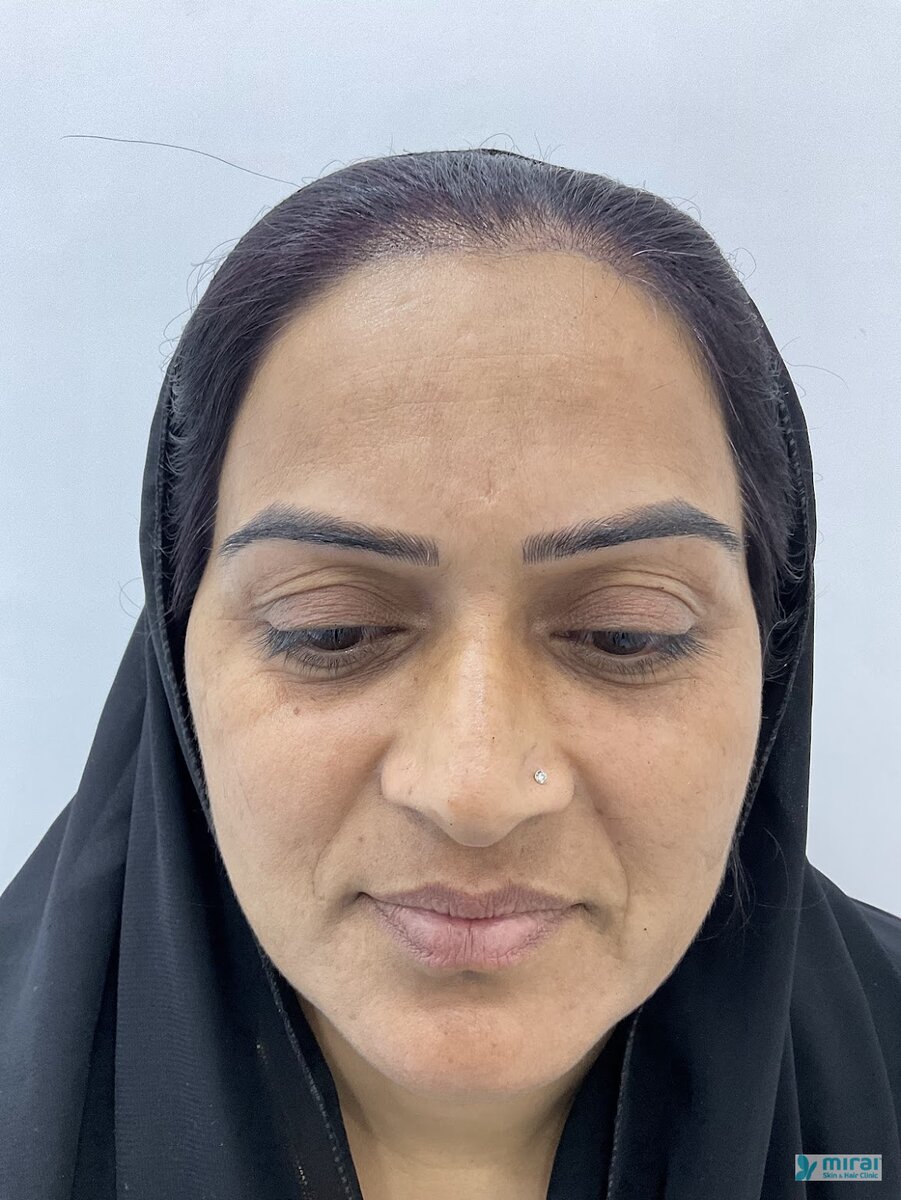 Shabanam - Before After Microblading