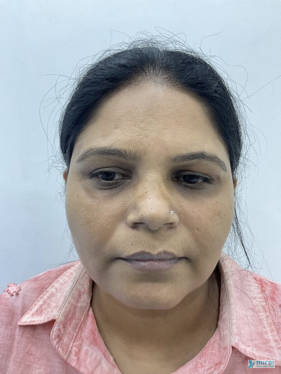 Surekha - Before After Microblading
