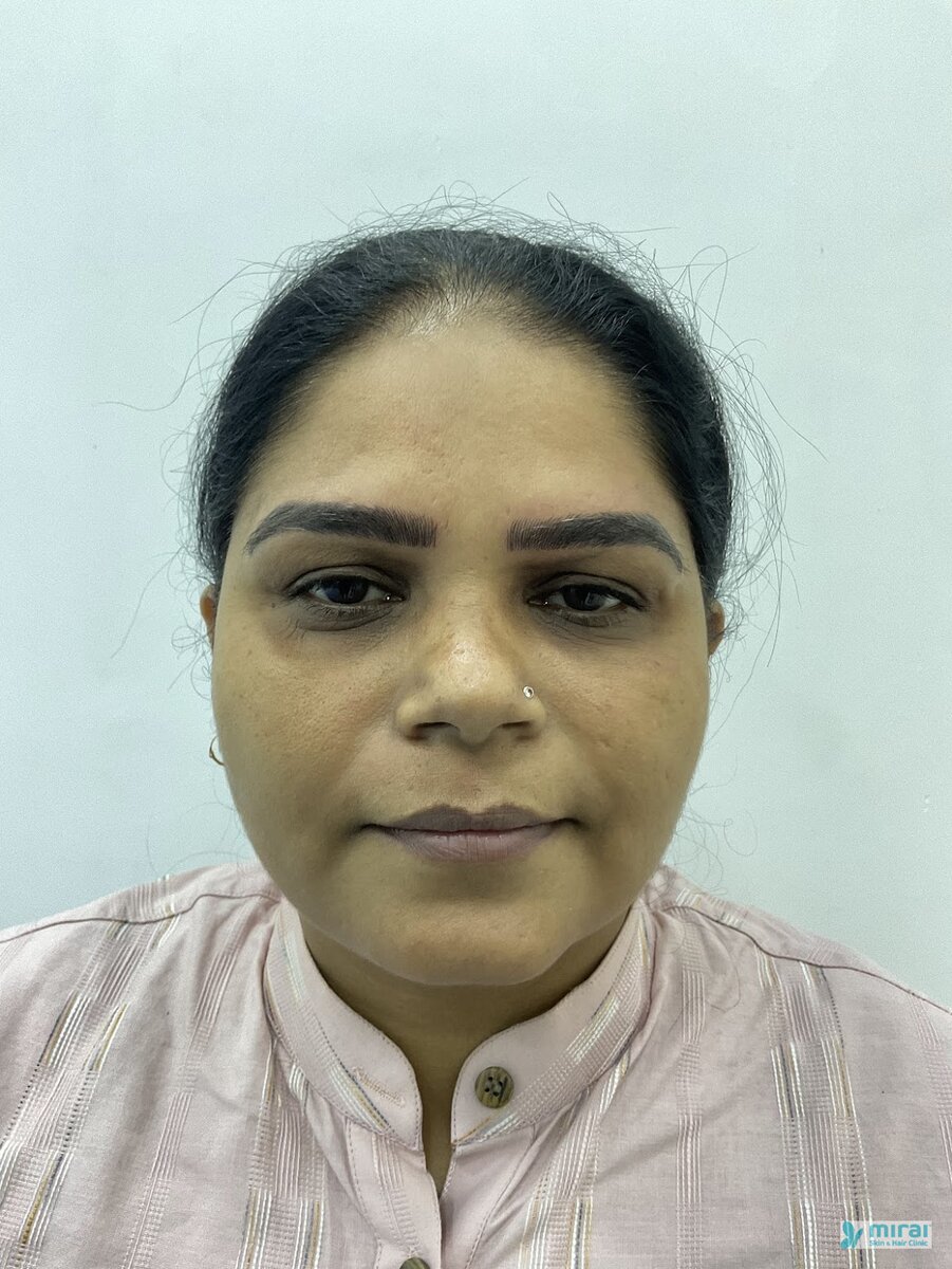 Surekha - Before After Microblading
